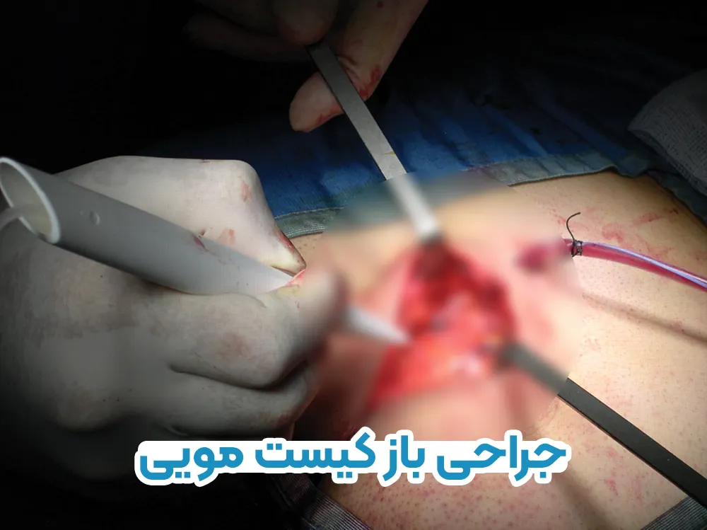 جراحی باز کیست مویی