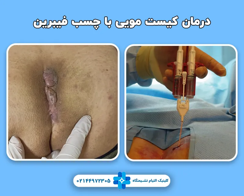 درمان کیست مویی با چسب فیبرین