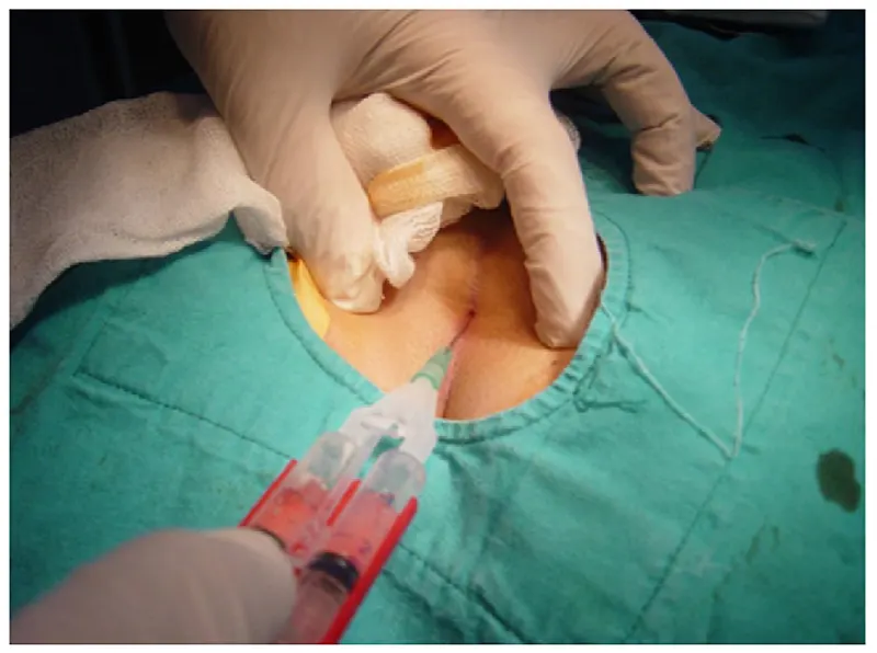 درمان کیست مویی با چسب فیبرین