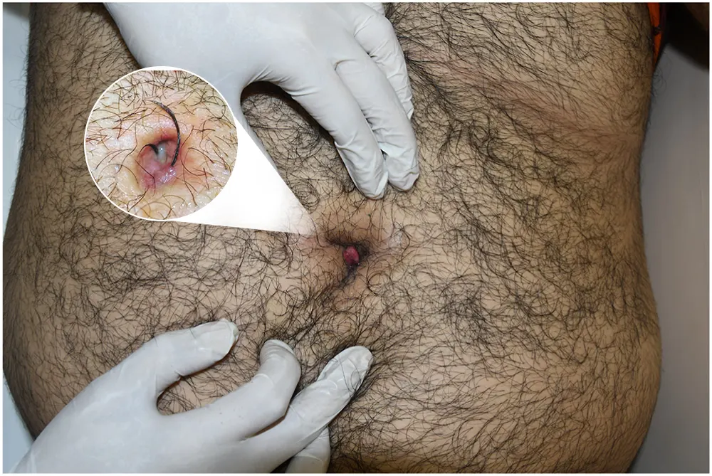 کیست مویی ناف