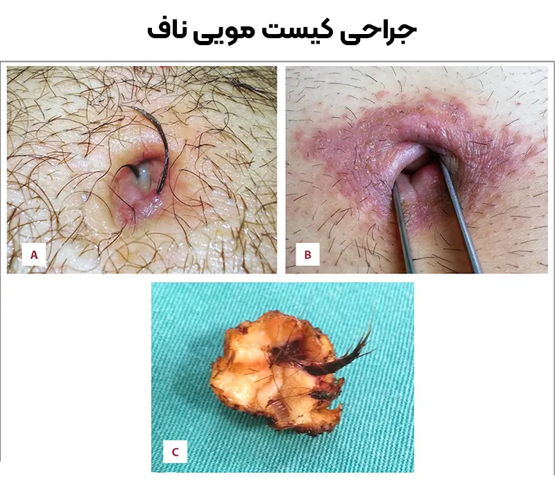 جراحی کیست مویی ناف