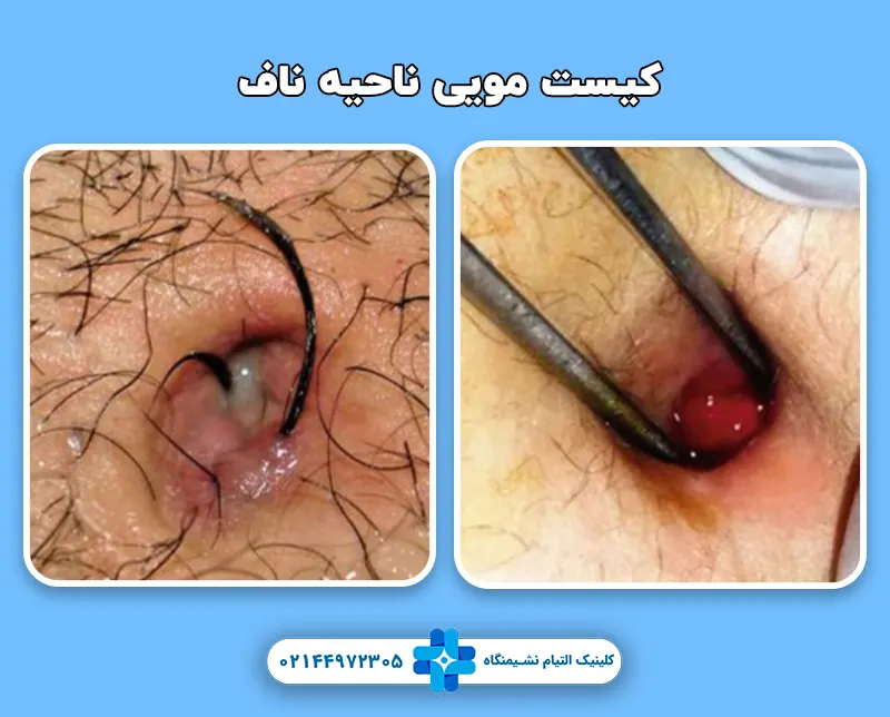 کیست مویی ناف