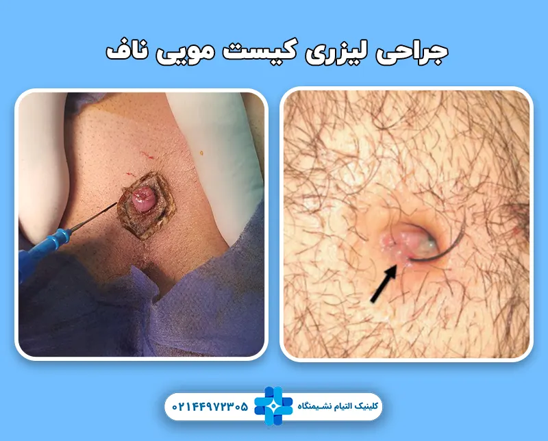 لیزر کیست مویی ناف