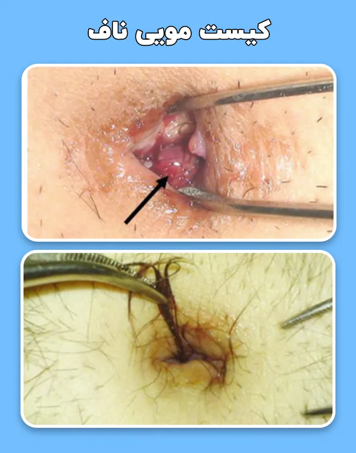 کیست مویی ناف