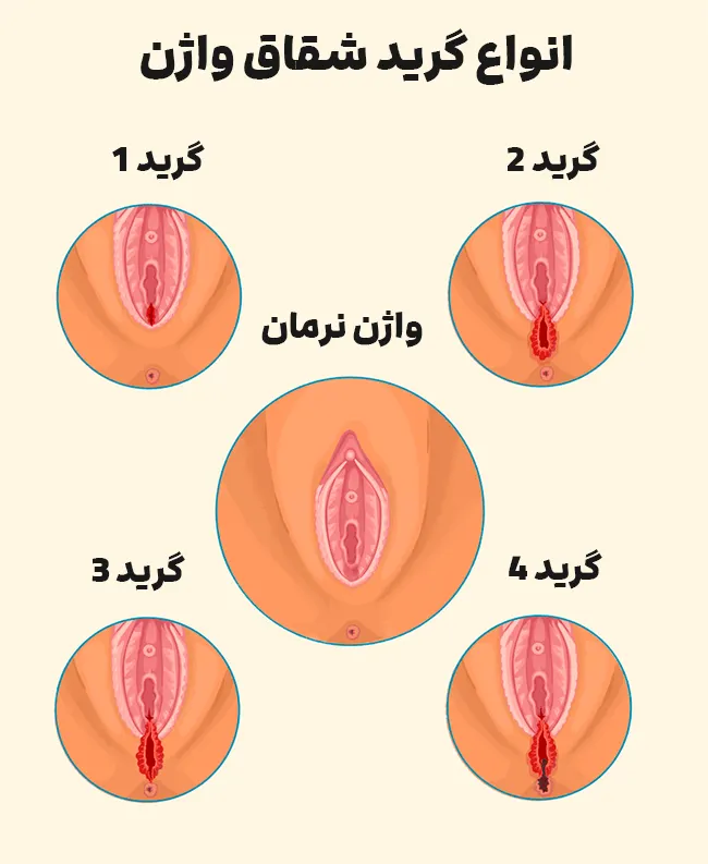 گرید و درجه شقاق واژن