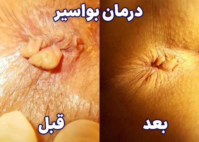 درمان بواسیر طب خیراندیش