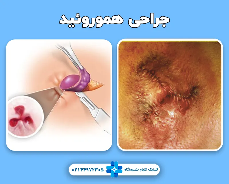 جراحی بواسیر