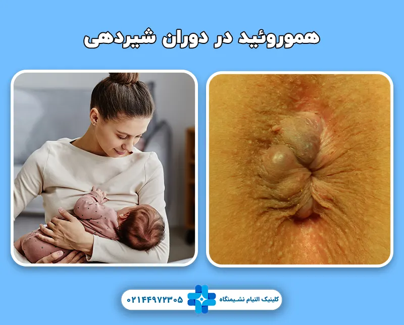 درمان هموروئید در دوران شیردهی