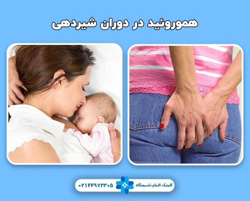 درمان هموروئید در دوران شیردهی