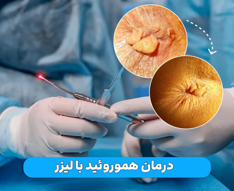 لیزر هموروئید