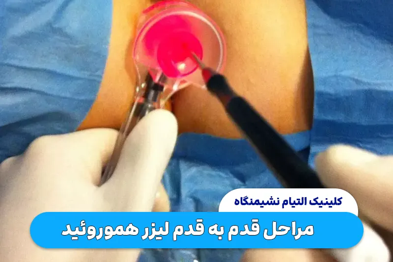 مراحل لیزر هموروئید