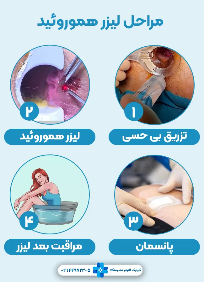 مراحل لیزر هموروئید