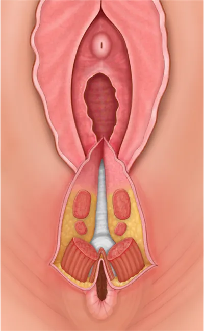 پارگی پرینه