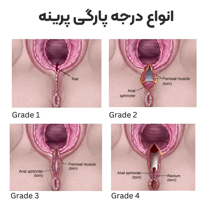 درجه پارگی پرینه