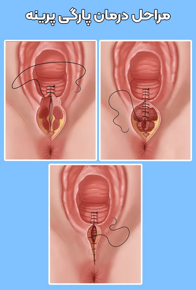 درمان پارگی پرینه