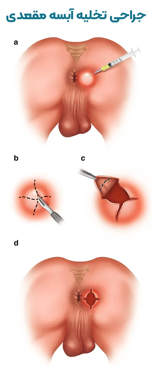 جراحی تخلیه آبسه مقعدی