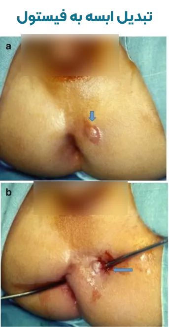 تبدیل آبسه به فیستول مقعد