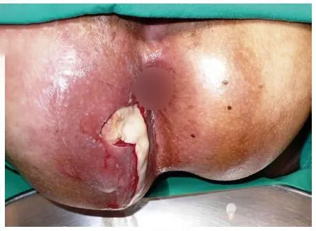 تخلیه آبسه مقعد