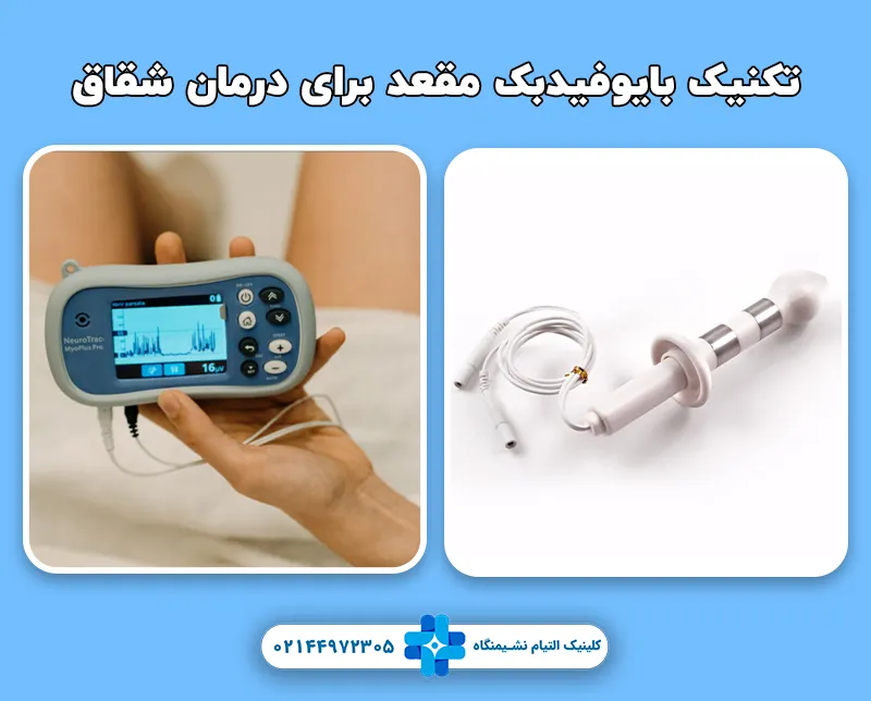 بایوفیدبک مقعد برای شقاق