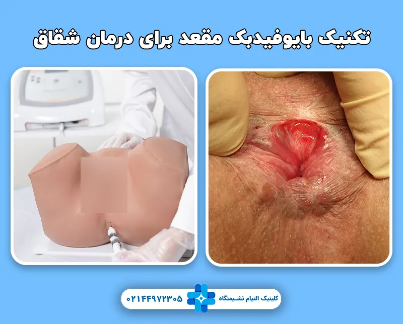 بایوفیدبک مقعد برای درمان شقاق
