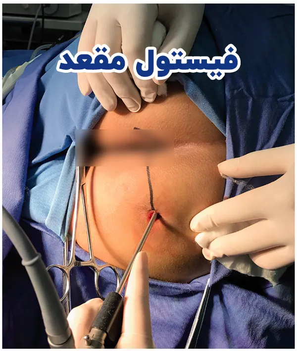 فیستول مقعد