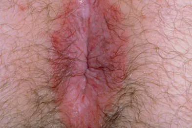 حساسیت مقعد