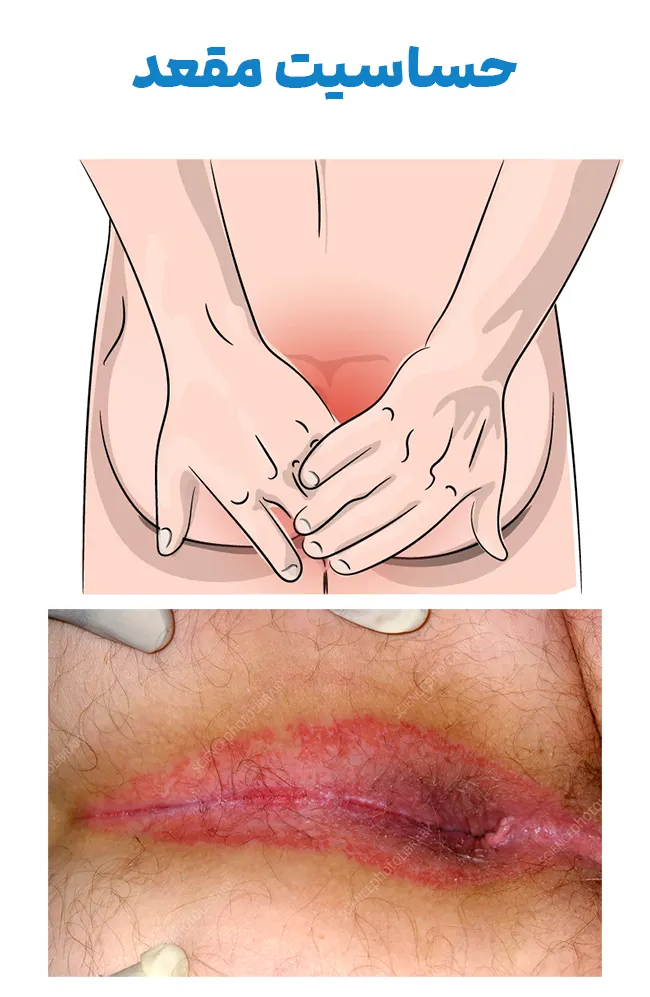 حساسیت مقعد