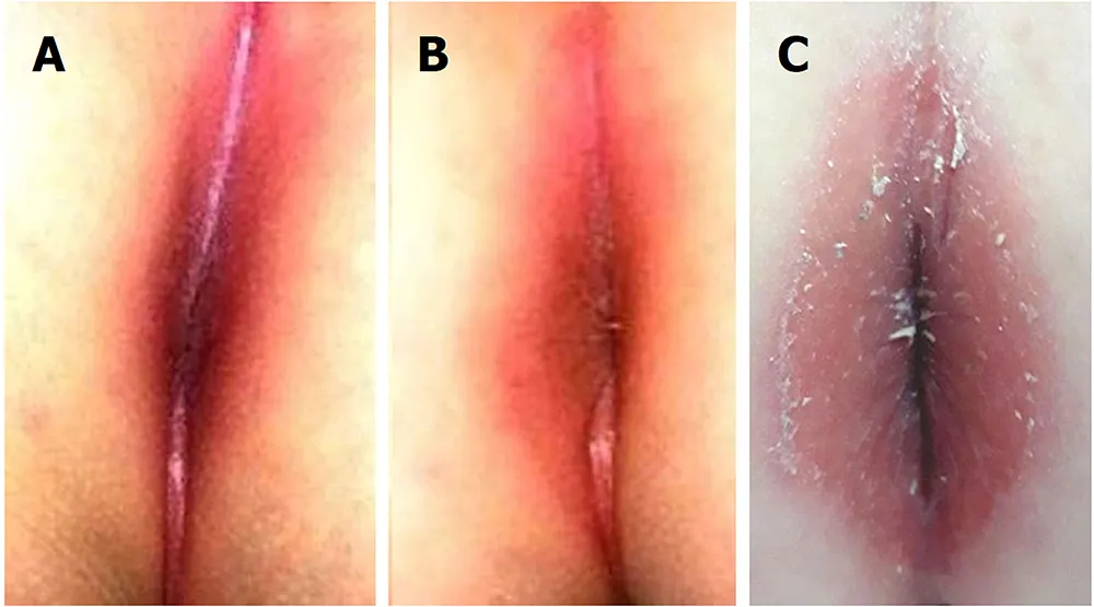 حساسیت مقعد