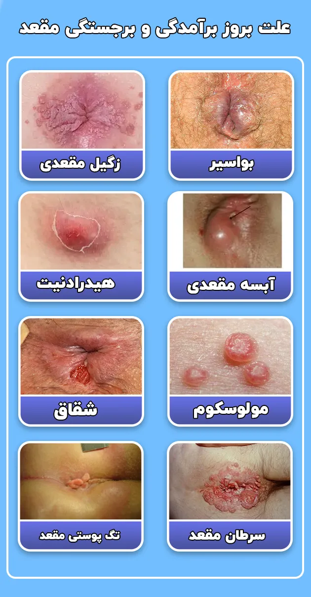 دلیل ورم مقعد