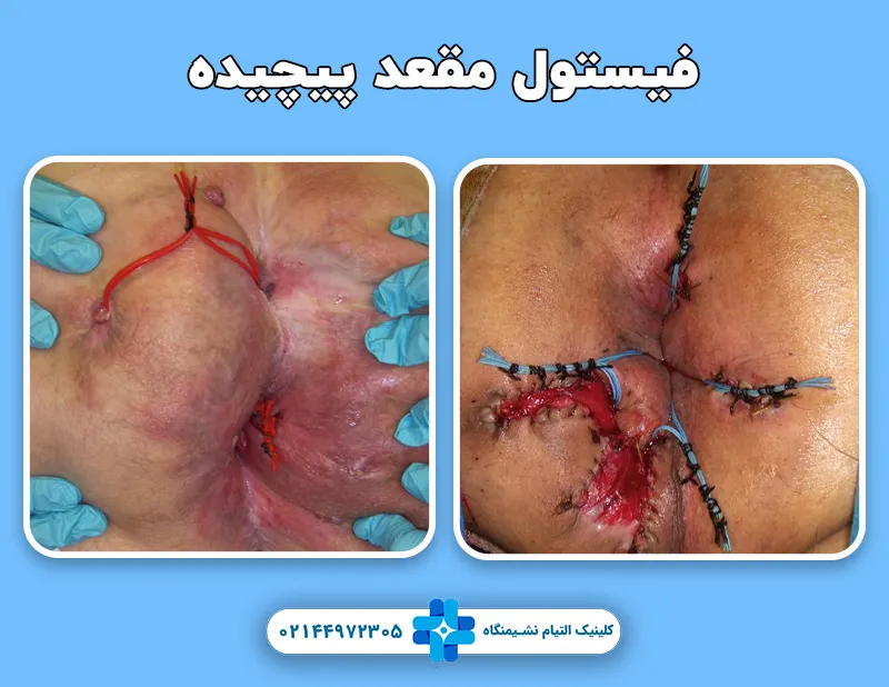 فیستول پیچیده