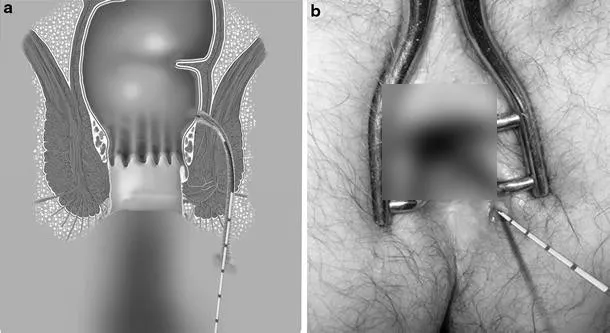 درمان فیستول