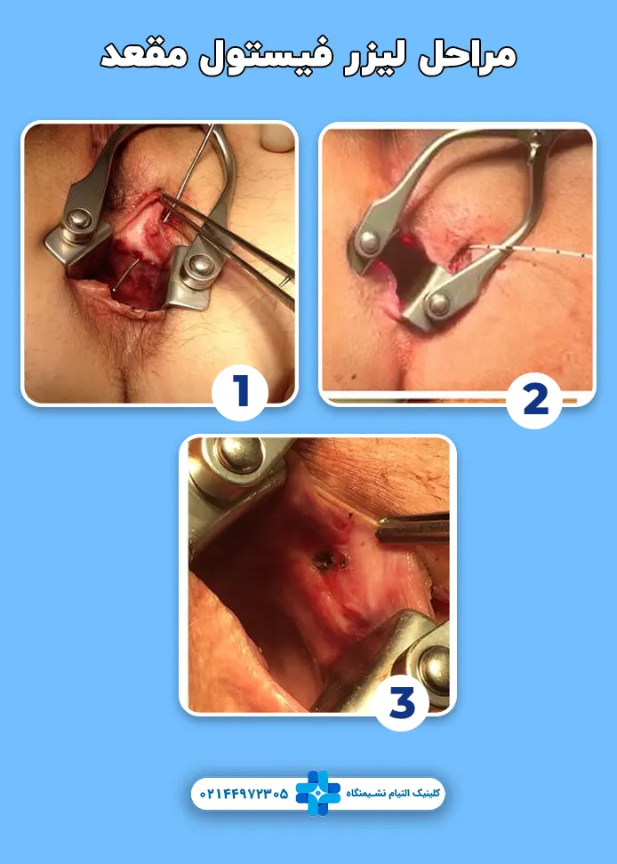 مراحل لیزر فیستول