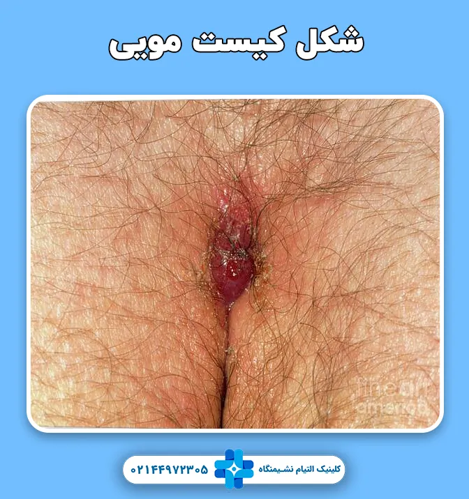 علائم کیست مویی