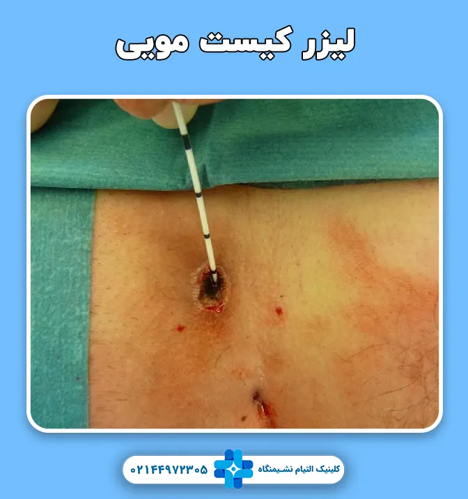 لیزر کیست مویی
