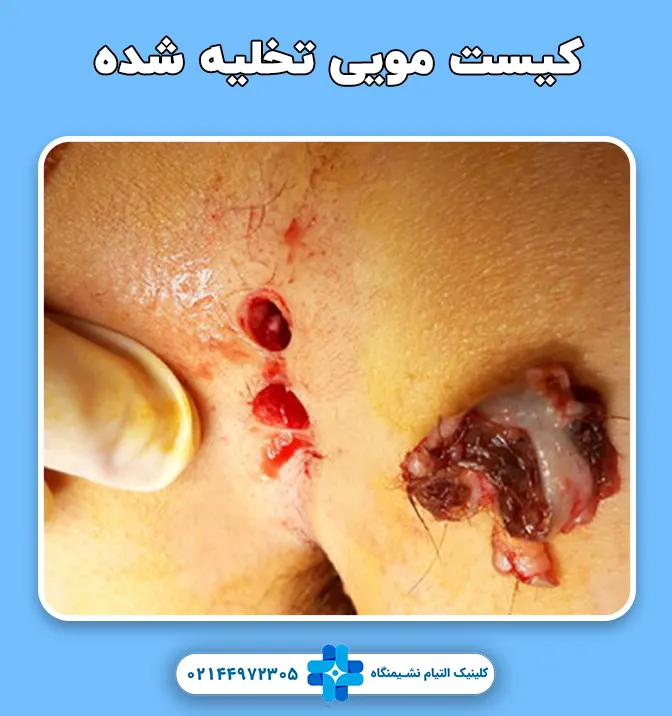 تخلیه کیست مویی