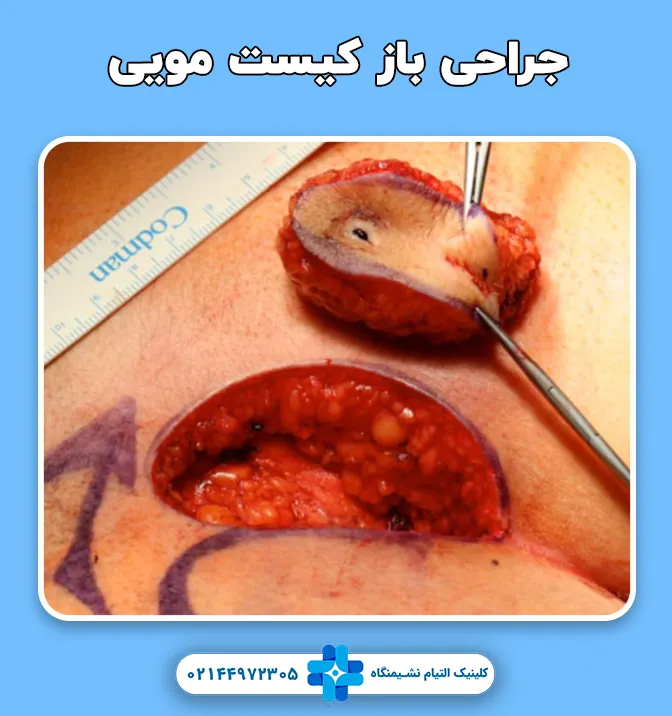 جراحی باز کیست مویی