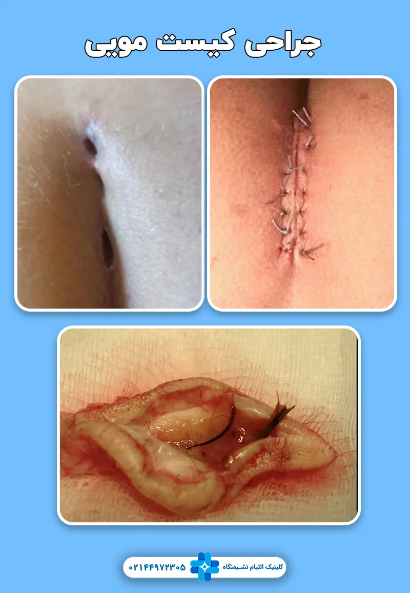 جراحی کیست مویی