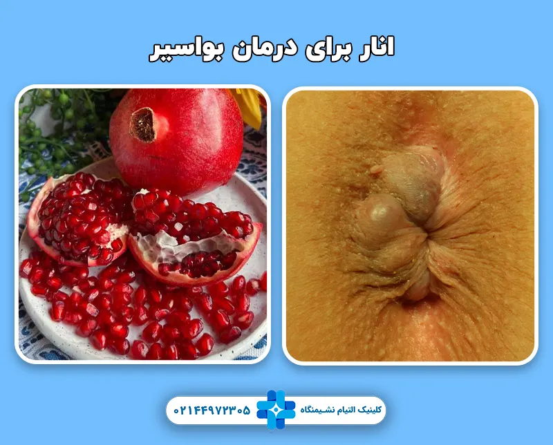 درمان بواسیر با انار