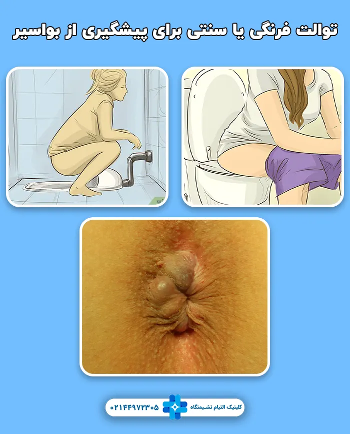 توالت فرنگی یا سنتی برای پیشگیری از بواسیر