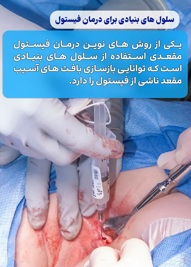 تزریق سلول‌ های بنیادی برای درمان فیستول مقعد