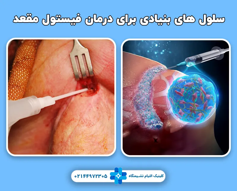 تزریق سلول‌ های بنیادی برای درمان فیستول مقعد