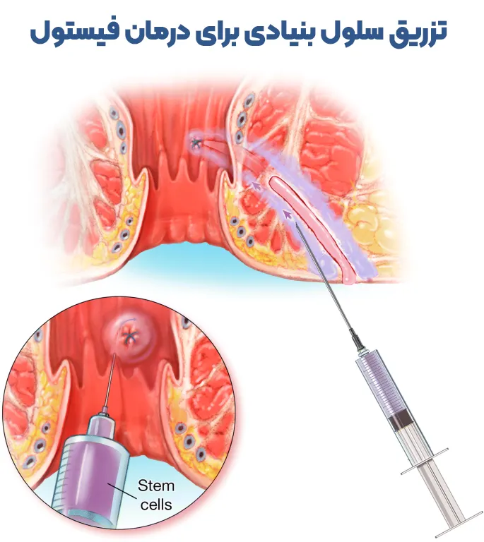 درمان فیستول مقعد با تزریق سلول‌ بنیادی