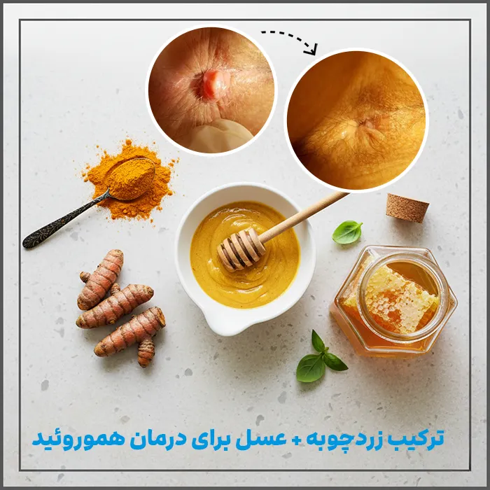 ترکیب زردچوبه و عسل برای درمان بواسیر