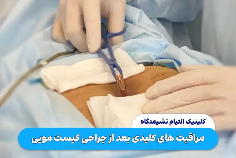 مراقبت های کلیدی بعد از جراحی کیست مویی