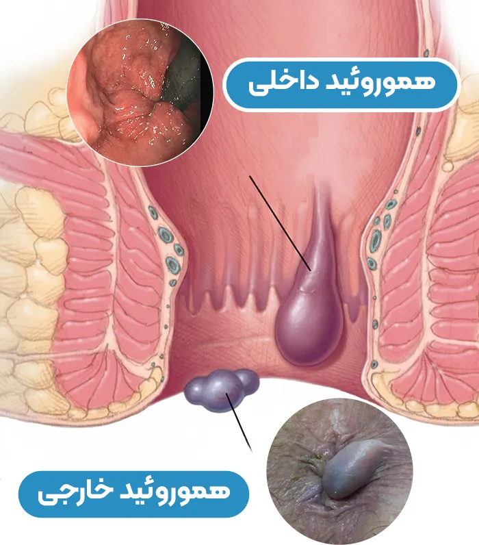 بواسیر چیست