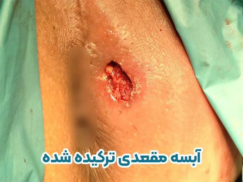 آبسه مقعد ترکیده