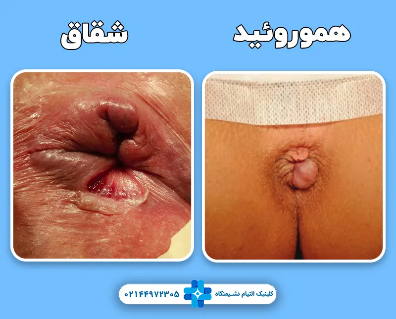 هموروئید و شقاق