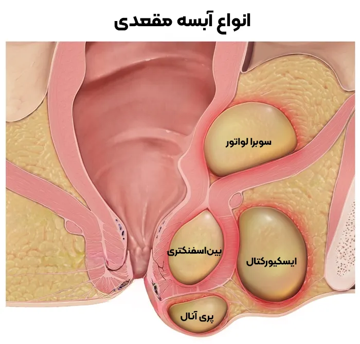 آبسه مقعد ناشی از انسداد غده مقعد