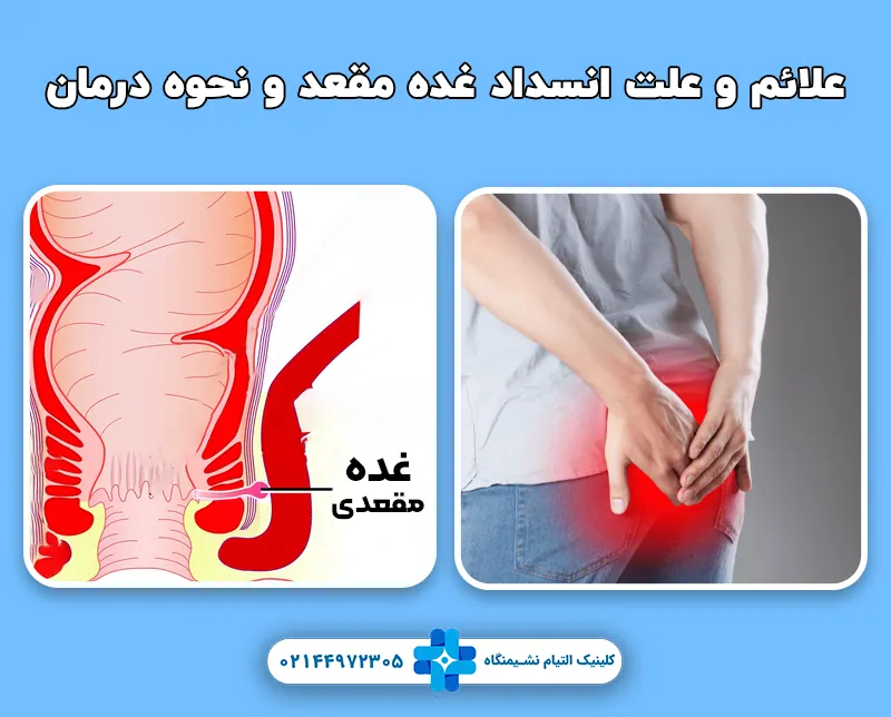 انسداد غده مقعد