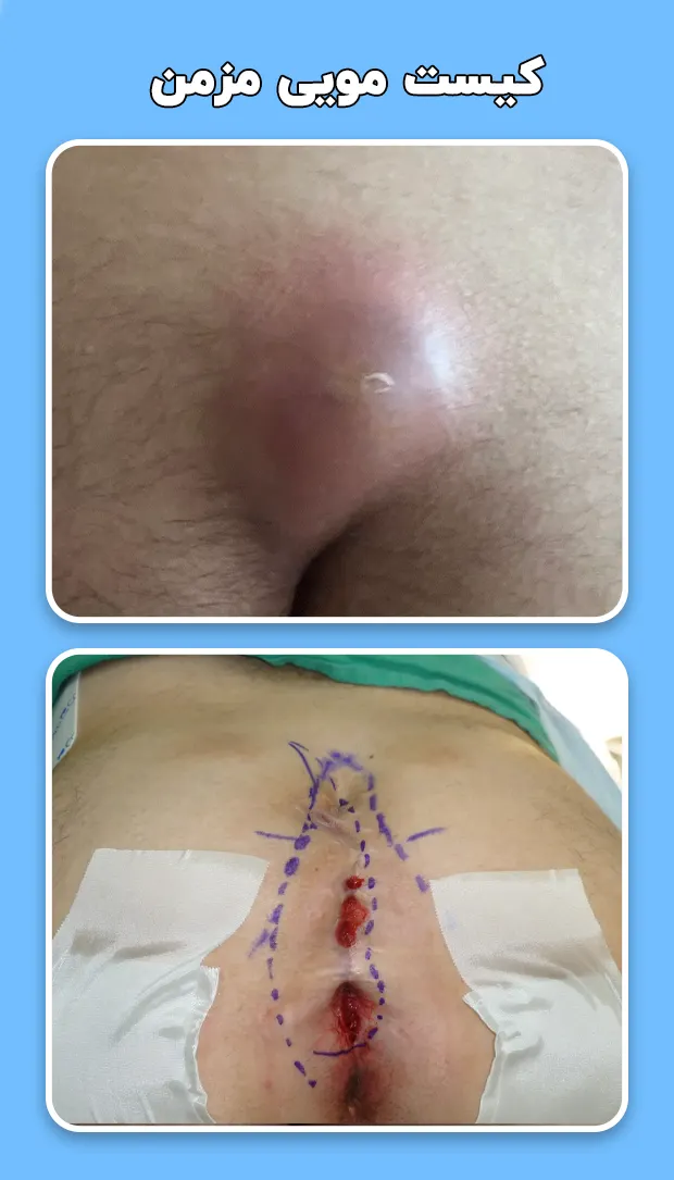 کیست‌ مویی مزمن